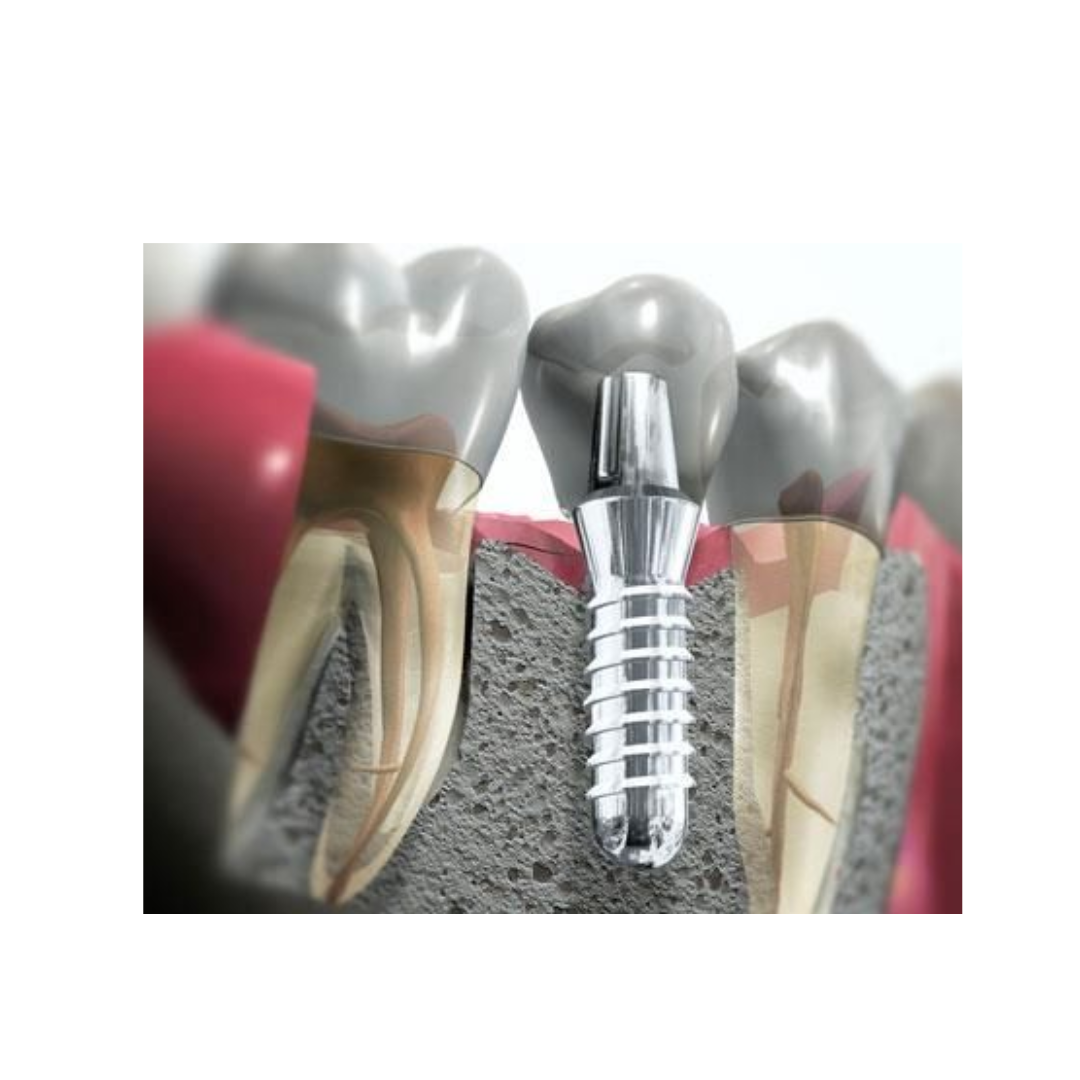 Oral Implantology